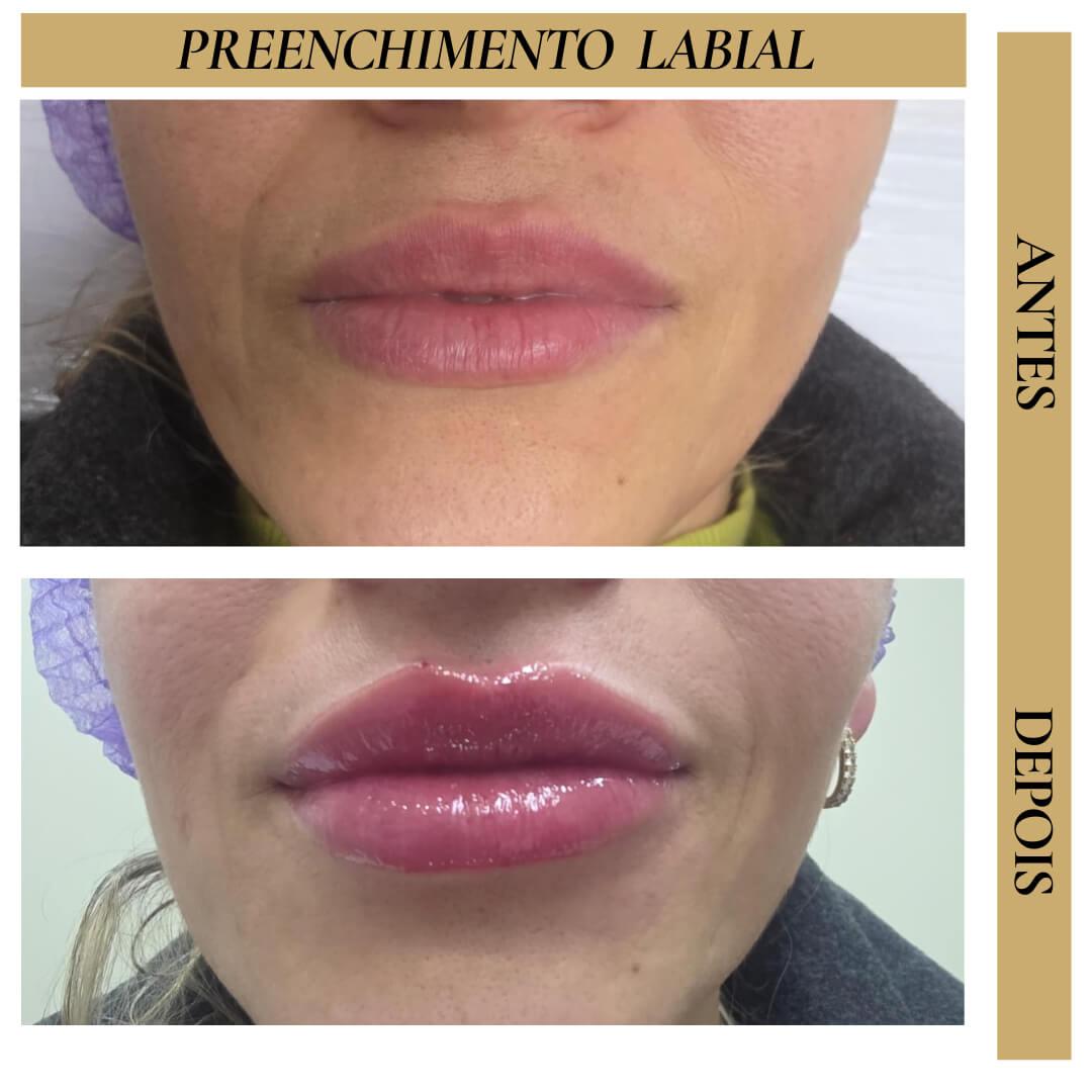Antes e Depois - Preenchimento Labial